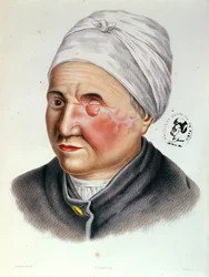 Illustration tirée du Traité de Chirurgie Plastique par Antoine Jobert de Lamballe (1799-1867) Paris, 1849